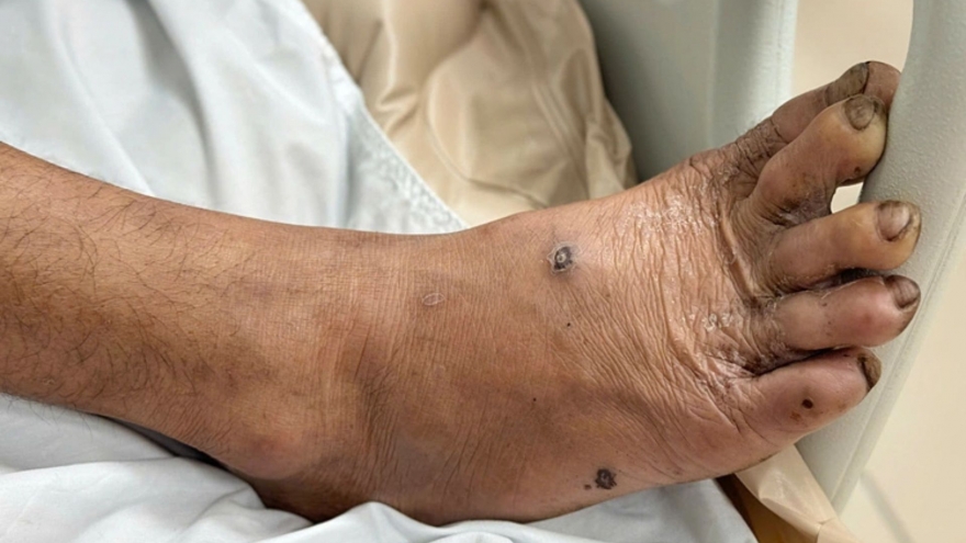 Chủ quan với vết thương nhỏ, nhiều bệnh nhân nhập viện vì uốn ván